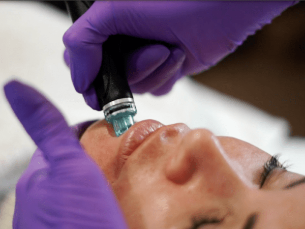 “HydraFacial deep cleansing and hydrating treatment enhancing skin clarity and glow as part of early anti-aging care in Melbourne.”