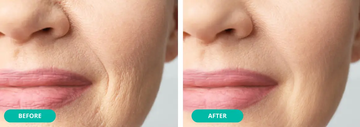 before after dermal fillers