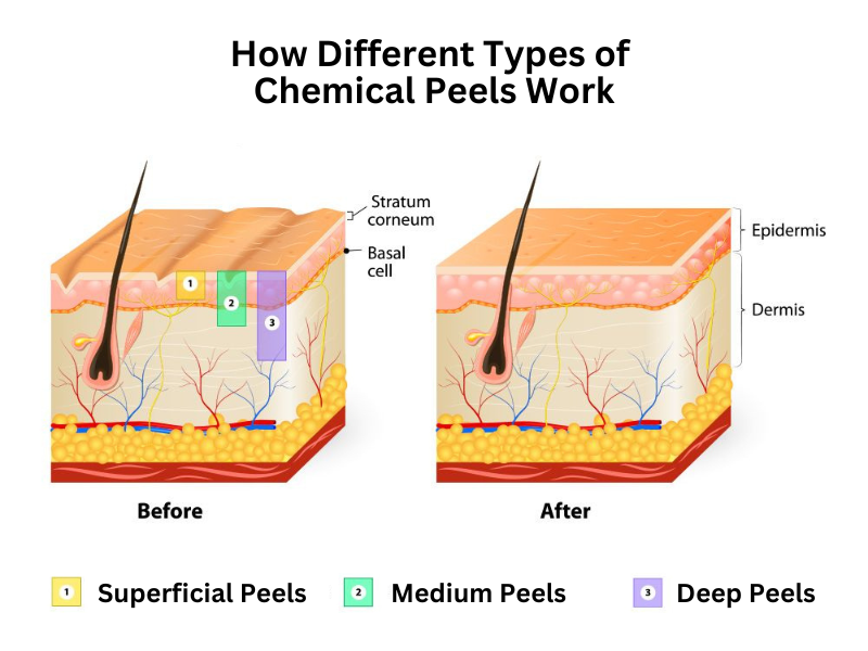 Chemical Peels Before & After