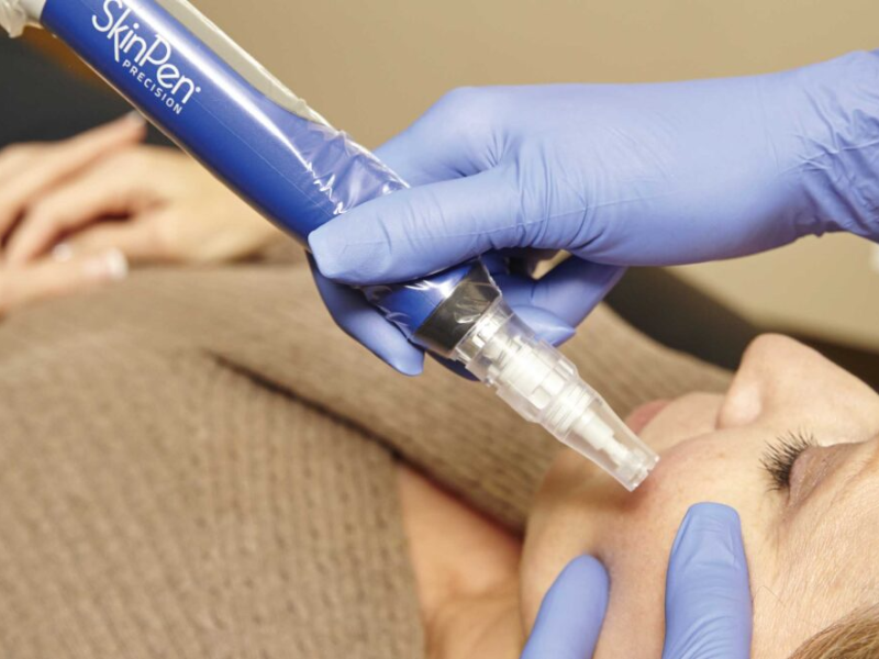 SkinPen Micro-needling device for lax skin post pregnancy mummy makeover