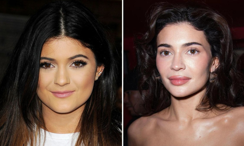 Overfilled Lips decreases facial balance and makes the results look unnatural