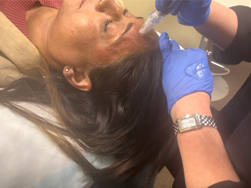 Microneedling (SkinPen) Close-up of microneedling treatment for smoother skin texture and fine line improvement. Facial Enhancement Melbourne