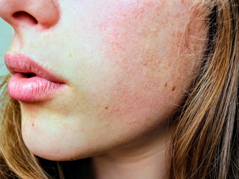 Natural Ways to Minimise Fine Lines Around the Mouth