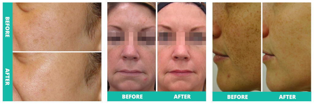 explanation ipl skin rejuvenation