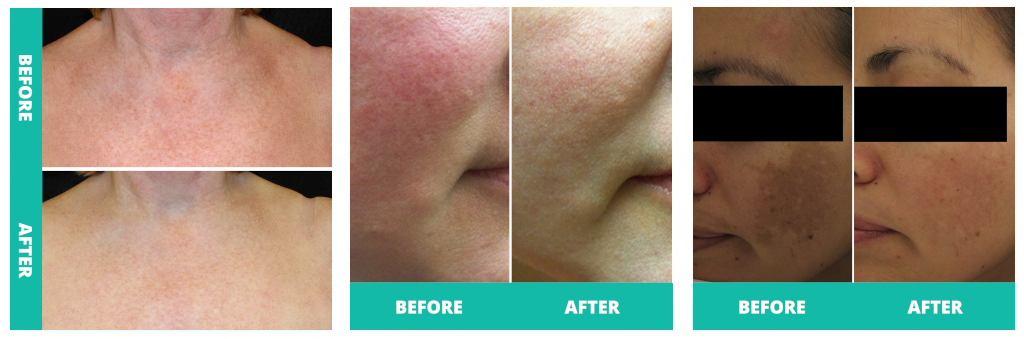 explanation ipl for skin rejuvenation