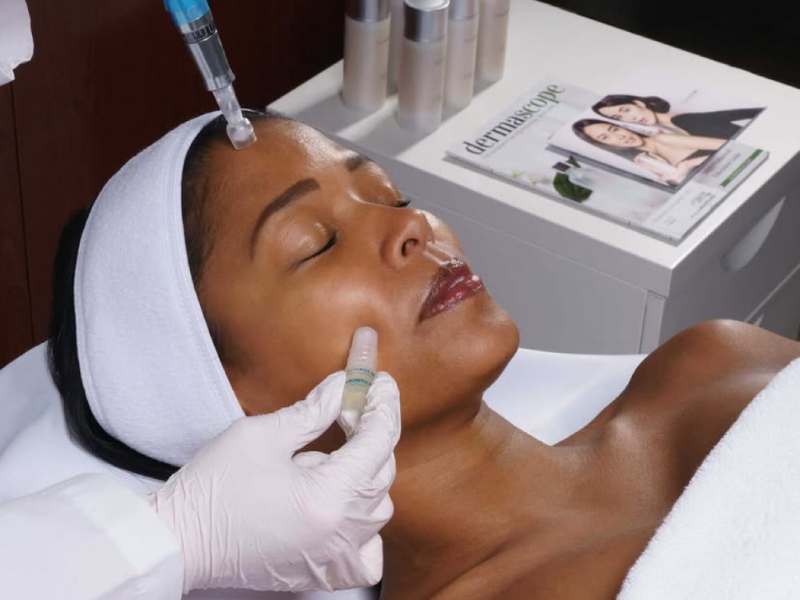 Microneedling with Exosomes-acne-scar-treatment-melbourne