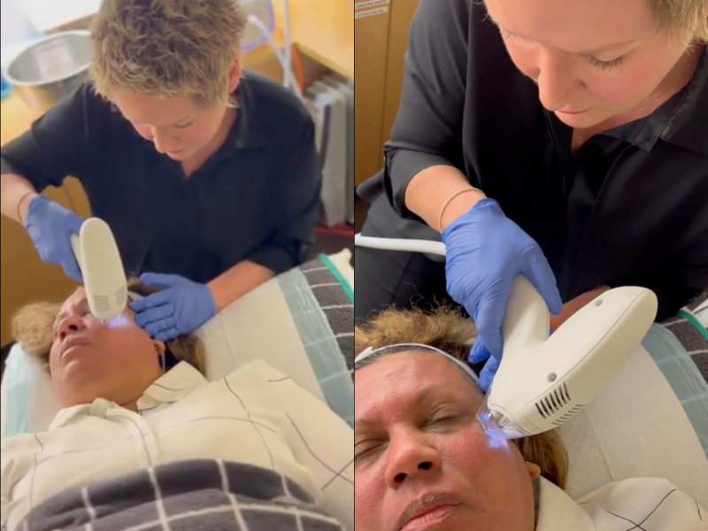 Tixel acne scar treatment melbourne