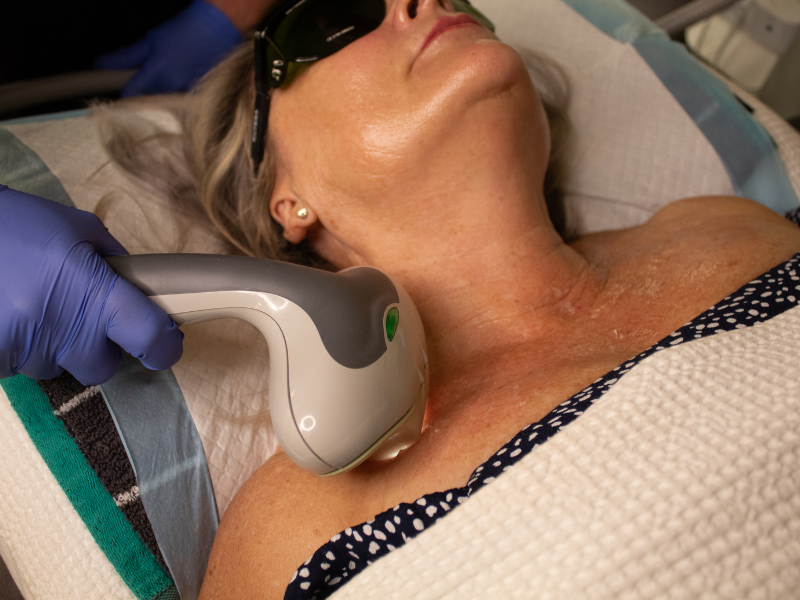 IPL skin rejuvenation targeting pigmentation and redness on the face and décolletage.