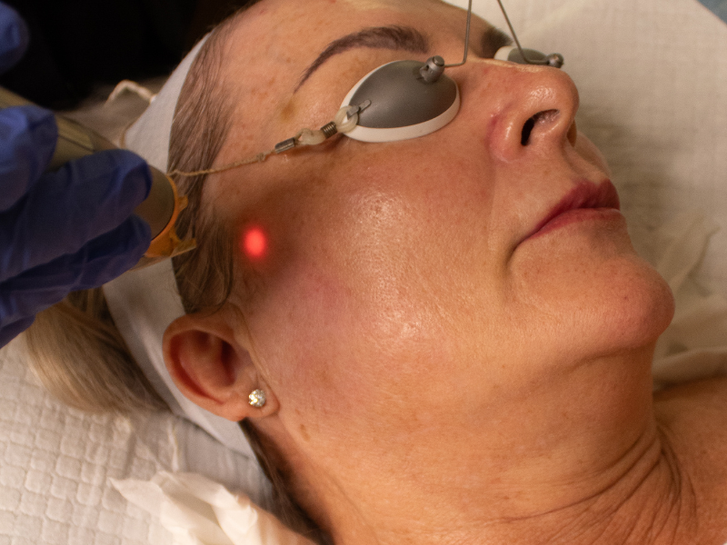 Non-invasive skin rejuvenation treatment in Melbourne clinic