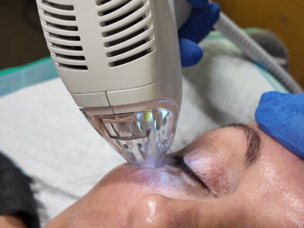 “Tixel skin rejuvenation treatment improving fine texture and firmness, supporting early anti-aging results in Melbourne clinic.”