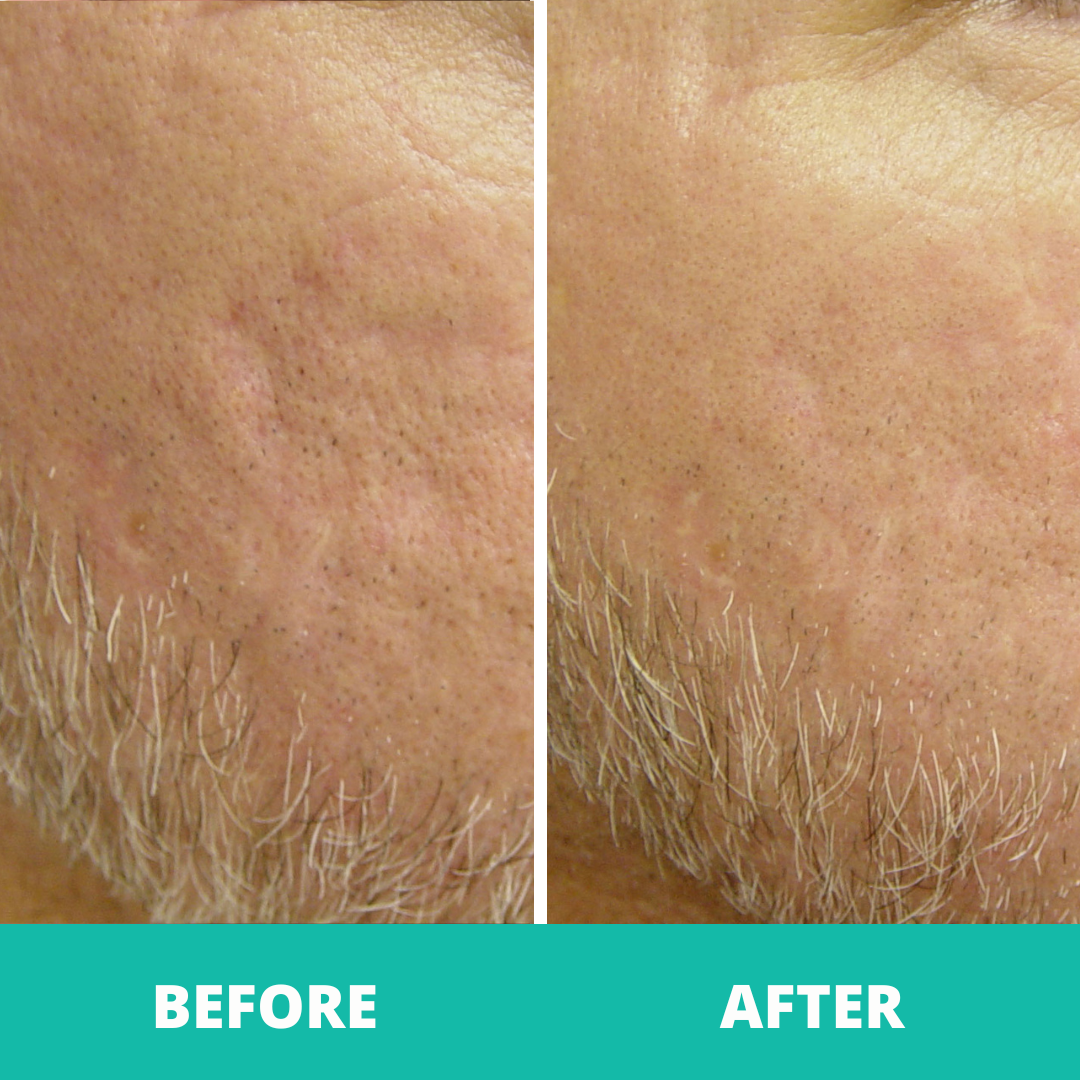 Laser Genesis treatment for men improving skin texture and tone non-surgical laser skin treatment for men in Melbourne Laser Genesis for men’s skin rejuvenation