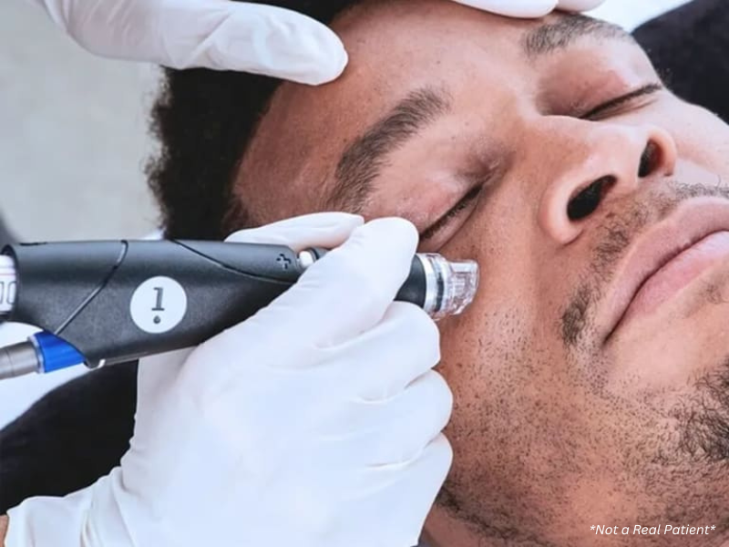 HydraFacial treatment for men in Melbourne to treat acne and congestion
