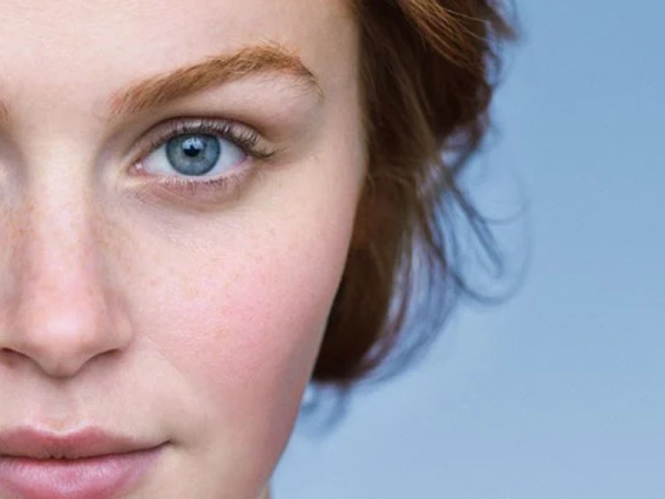 Woman with visible facial redness showing common rosacea symptoms on cheeks