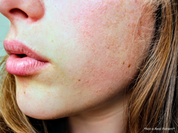 Close-up of rosacea with visible blood vessels and skin inflammation